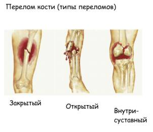 Типы переломов костей