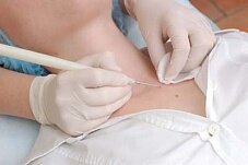 Как вылечить папилломы?