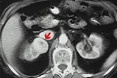 Женщины не знают симптомов рака яичников